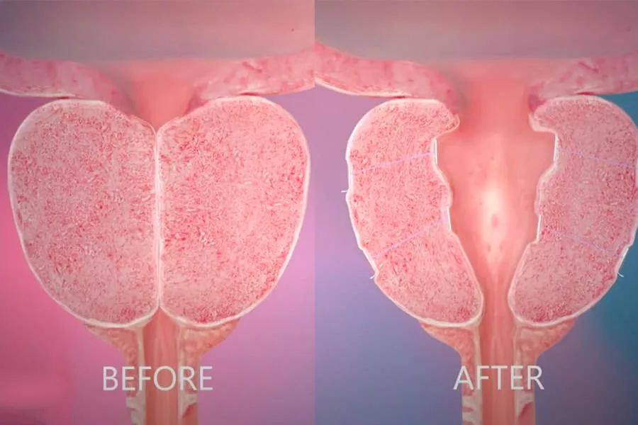 UroLift & Rezum Prostate Treatment