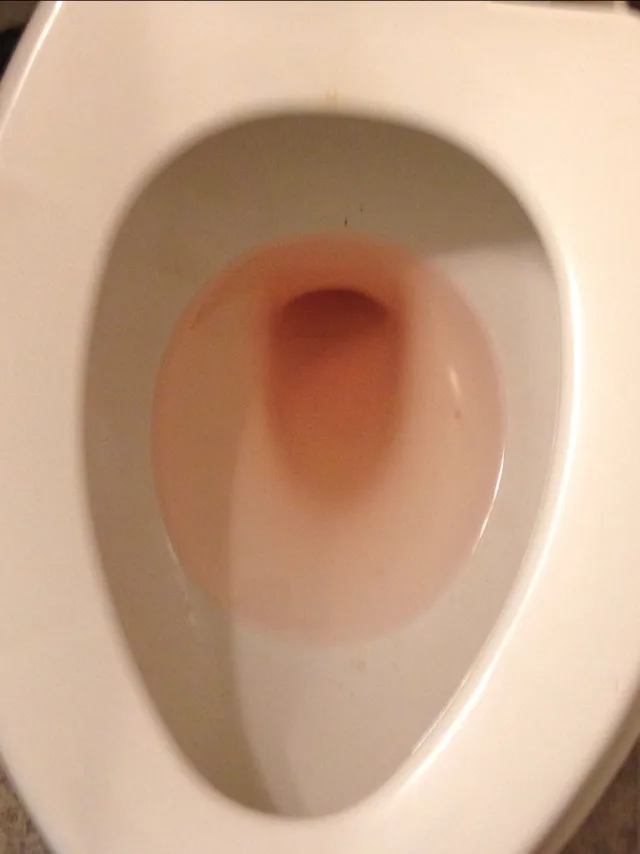 Blood in Urine (Hematuria): Causes, Tests & When to See a Urologist